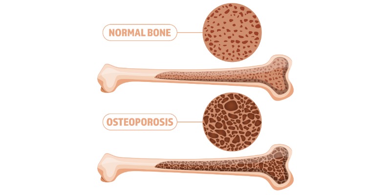 https://www.bodyconvert.it/ - QUALI ESERCIZI FISICI PER PREVENIRE E CONTENERE L’OSTEOPOROSI?